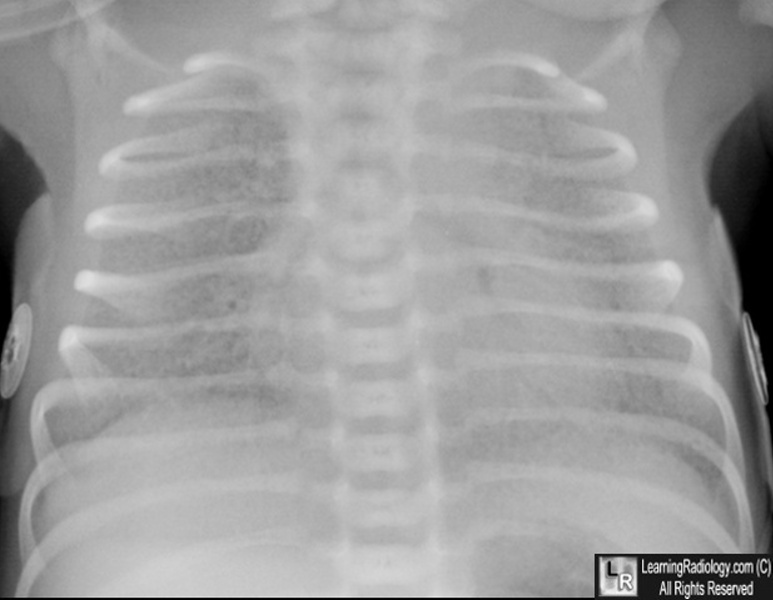 Respiratory Distress Syndrome Ground Glass