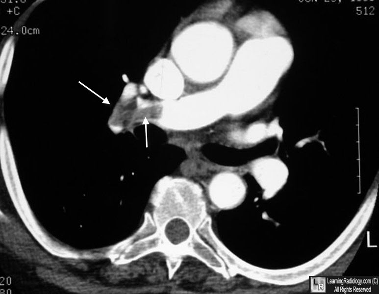 saddle pulmonary embolism xray