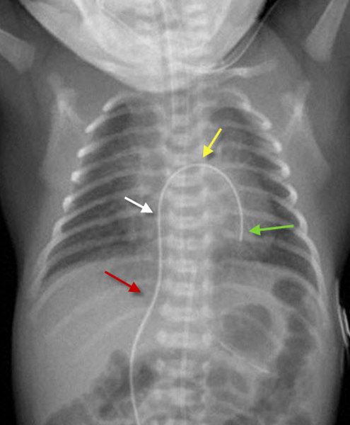 Learning Radiology Umbilical Venous Catheter In Left, 44% OFF