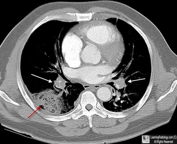 Pulmonary Embolism Chest X Ray