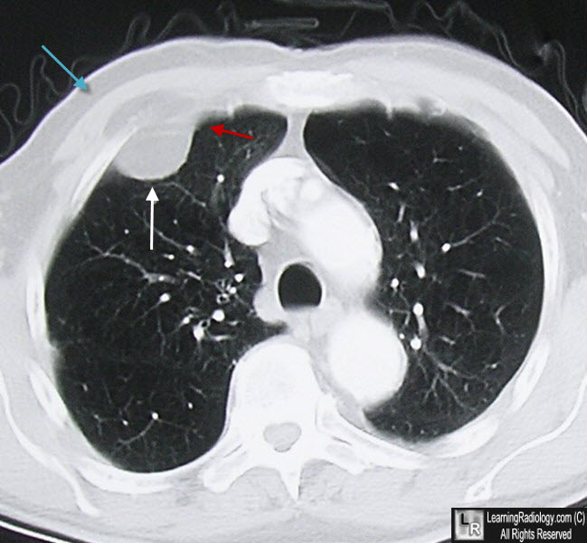 LearningRadiology - pleural, lipoma, extrapleural