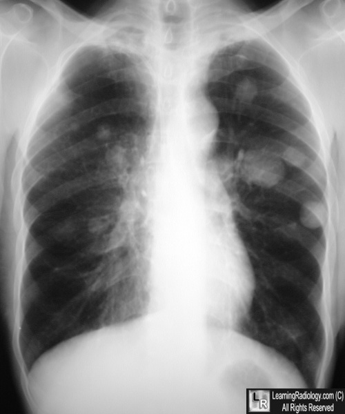 Multiple Nodular Metastases to Lung