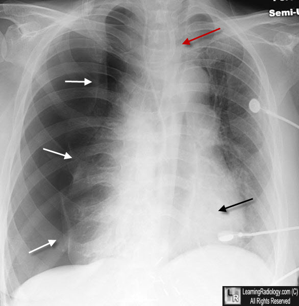Tension Pneumothorax X Ray - vrogue.co
