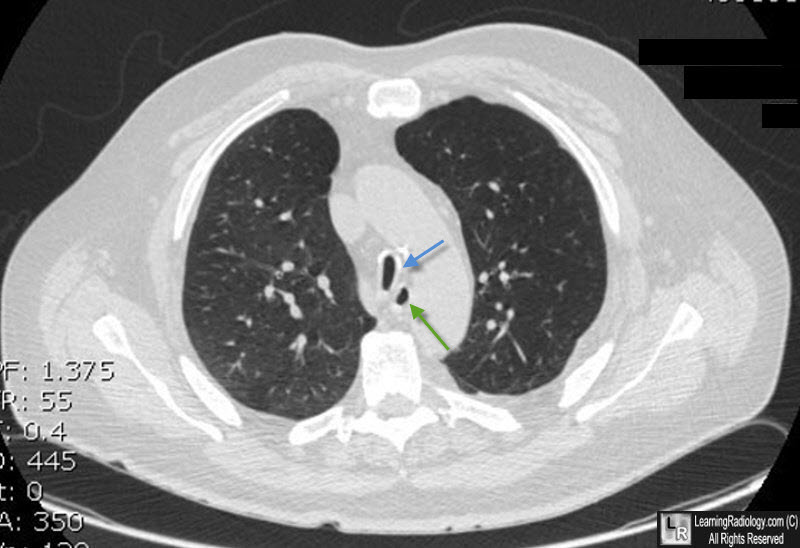 Learning Radiology - Saber Sheath Deformity of Trachea