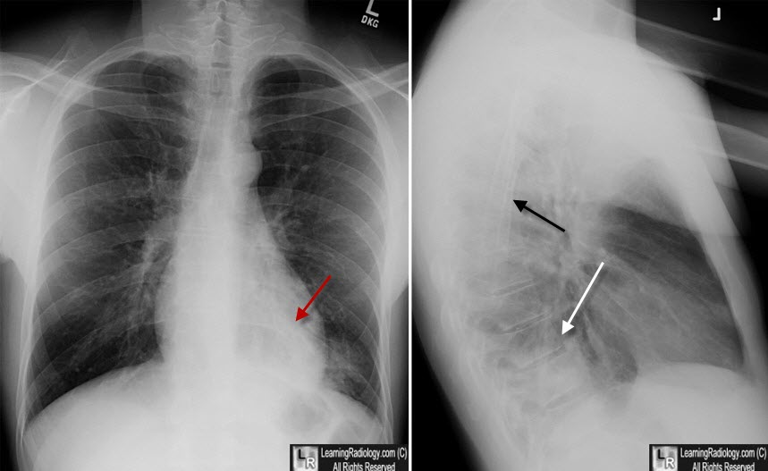 normal lateral chest xray