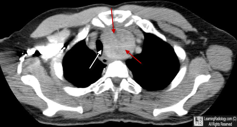 Learning Radiology - Substernal, Thyroid, Goiter