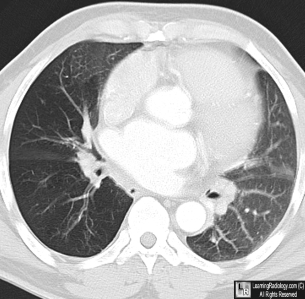 Learning Radiology - Swyer-James, Syndrome, MacLeod