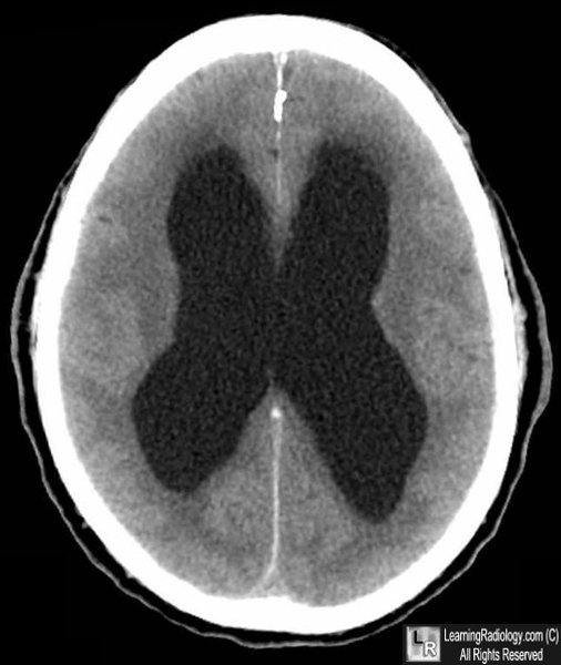 Learning Radiology Hydrocephalus