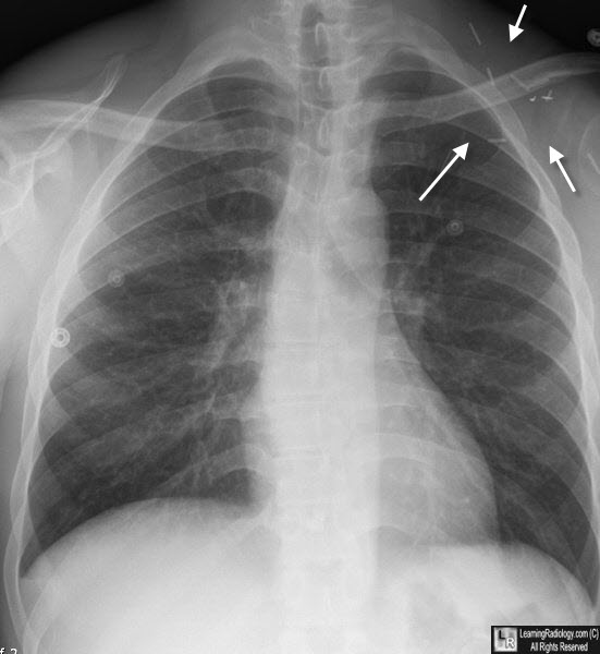 Learning Radiology - carpectomy, scapulectomy, patellectomy