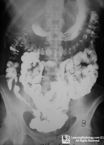 Crohn's Disease and Skip Lesions: What's the Significance?