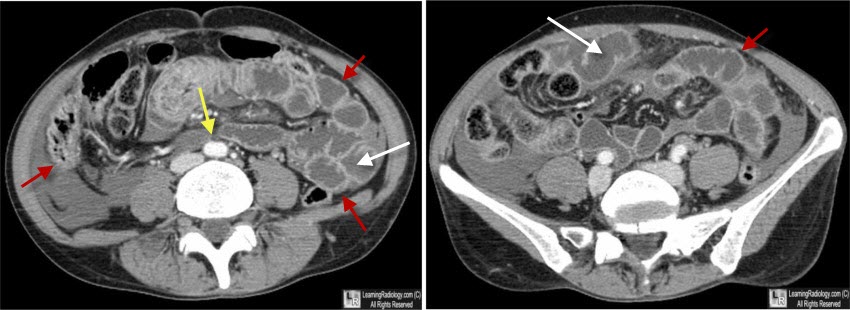 Learning Radiology - Shock Bowel, CT Hypotension Complex