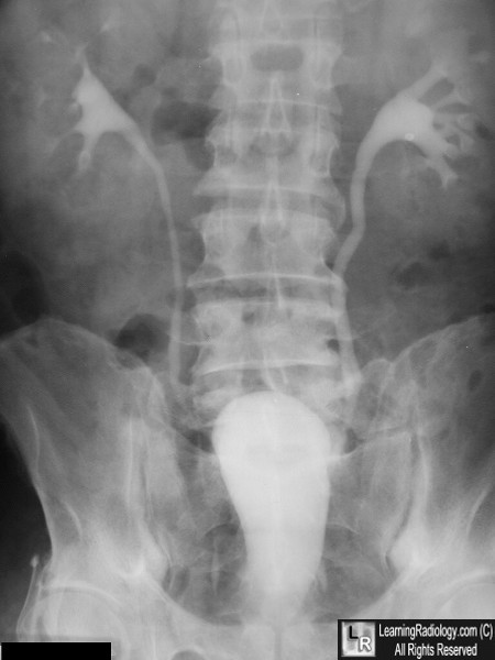 Pear-shaped bladder, Radiology Reference Article