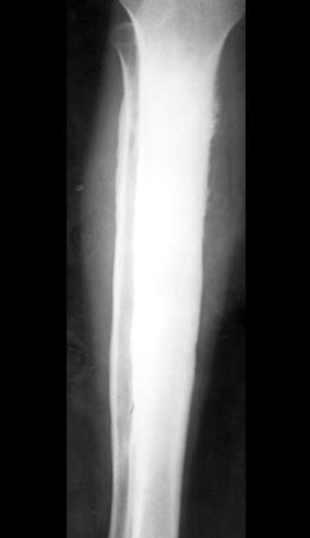 LearningRadiology-Bone Tumors