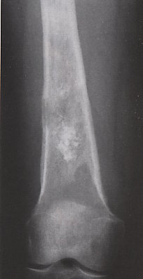 LearningRadiology-Bone Tumors