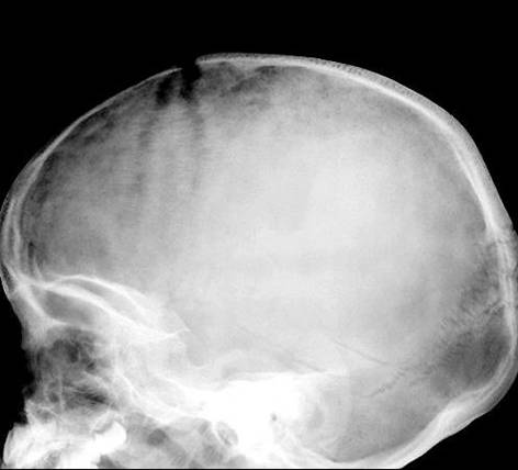 LearningRadiology-Bone Tumors