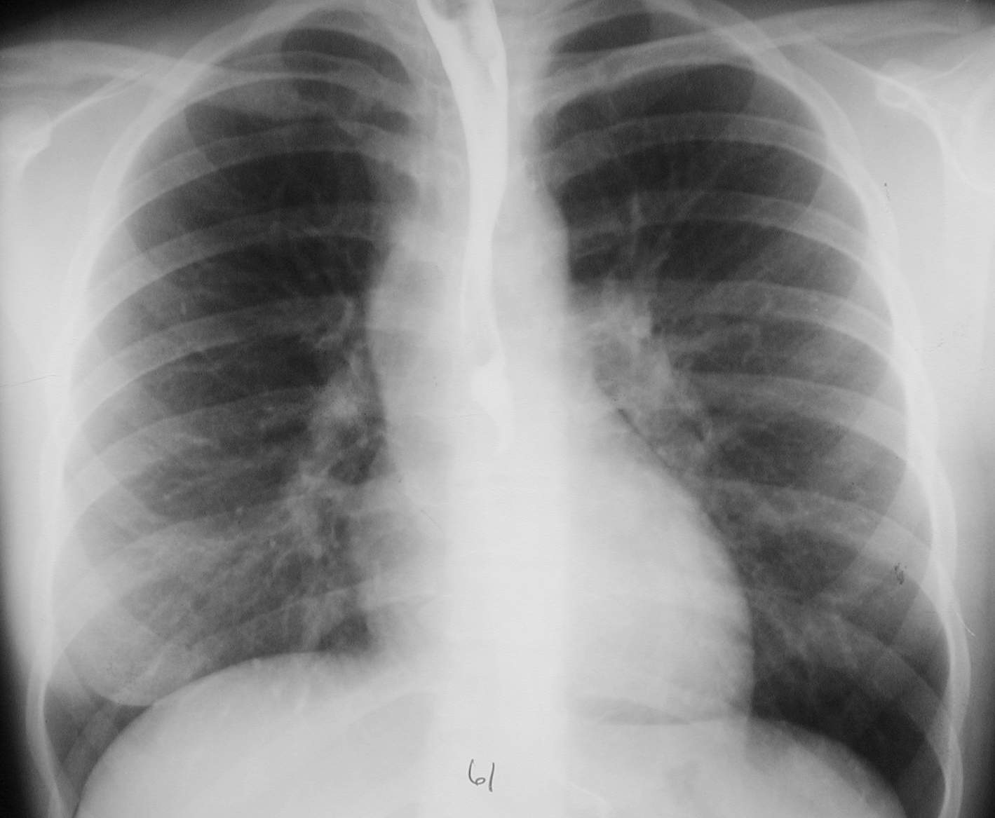 Congenital Heart Disease-Overview