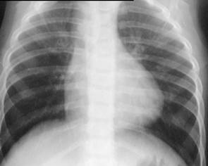 LearningRadiology- Cyanotic Heart Disease