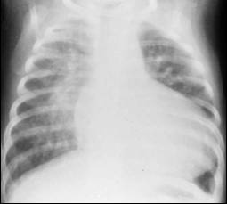 LearningRadiology- Cyanotic Heart Disease