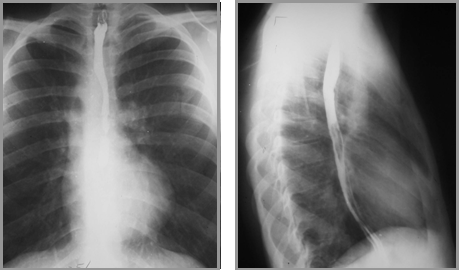 LearningRadiology - Diseases of the Great Vessels