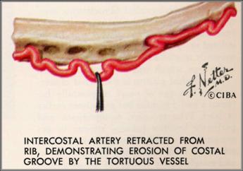 LearningRadiology-Obstrictive Cardiac Lesions, CHF, Infancy