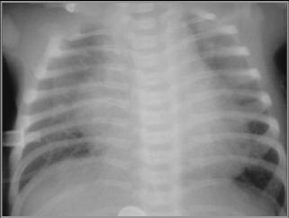 LearningRadiology-Obstrictive Cardiac Lesions, CHF, Infancy