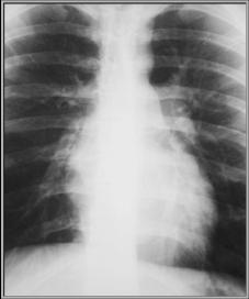 LearningRadiolgy.comn- Valvular Lesions of the Heart,pulmonic,tricuspid ...