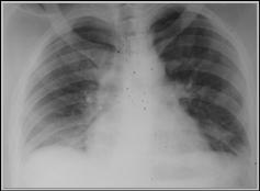 LearningRadiology.com - Diseases of The Diaphragm