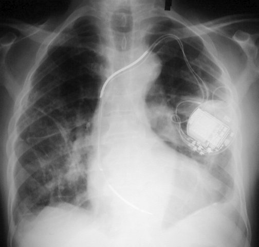 The Fundamentals of Chest Roentgenology