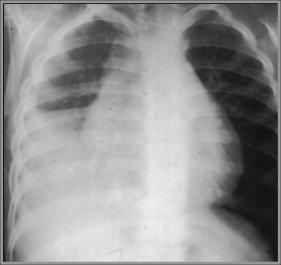 LearningRadiology - Pneumonia