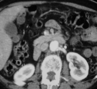 Acute Abdominal Pain and CT