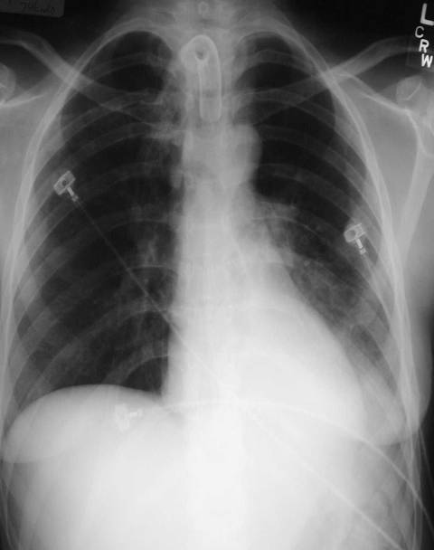 Basic Chest X-Ray Interpretation