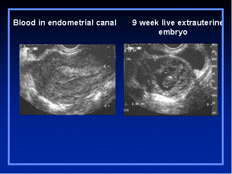 Ectopic Pregnancy