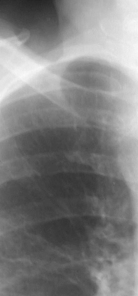 RUL nodule under 1st rib 2