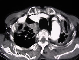 G:\photos\Chest Wall\apical extrapleural fat Vu old TB\ct1.jpg