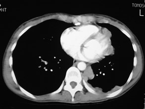 G:\photos\pleura\mesothelioma Ahn 37 yo\ct8.jpg