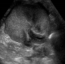 Ultrasound and Correlative Imaging of Renal Transplants-MH