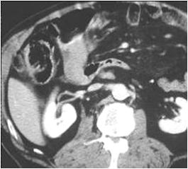 LearningRadiology.com-Acute Abdominal Emergencies