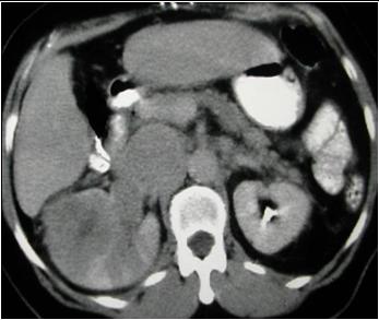 LearningRadiology.com-Flank Pain