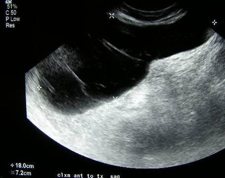 learningRadiology-Ultrasound of Renal Transplantation,US,kidney ...