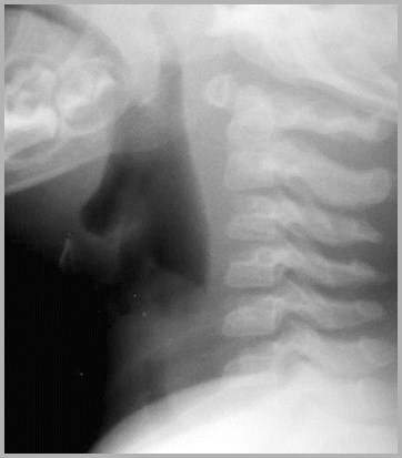 Plain lateral film of the neck showing soft tissue swelling and gas