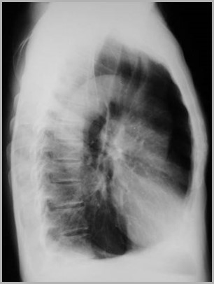 COPD-lateral