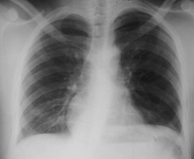 LearningRadiology - Recognizing Cardiomegaly