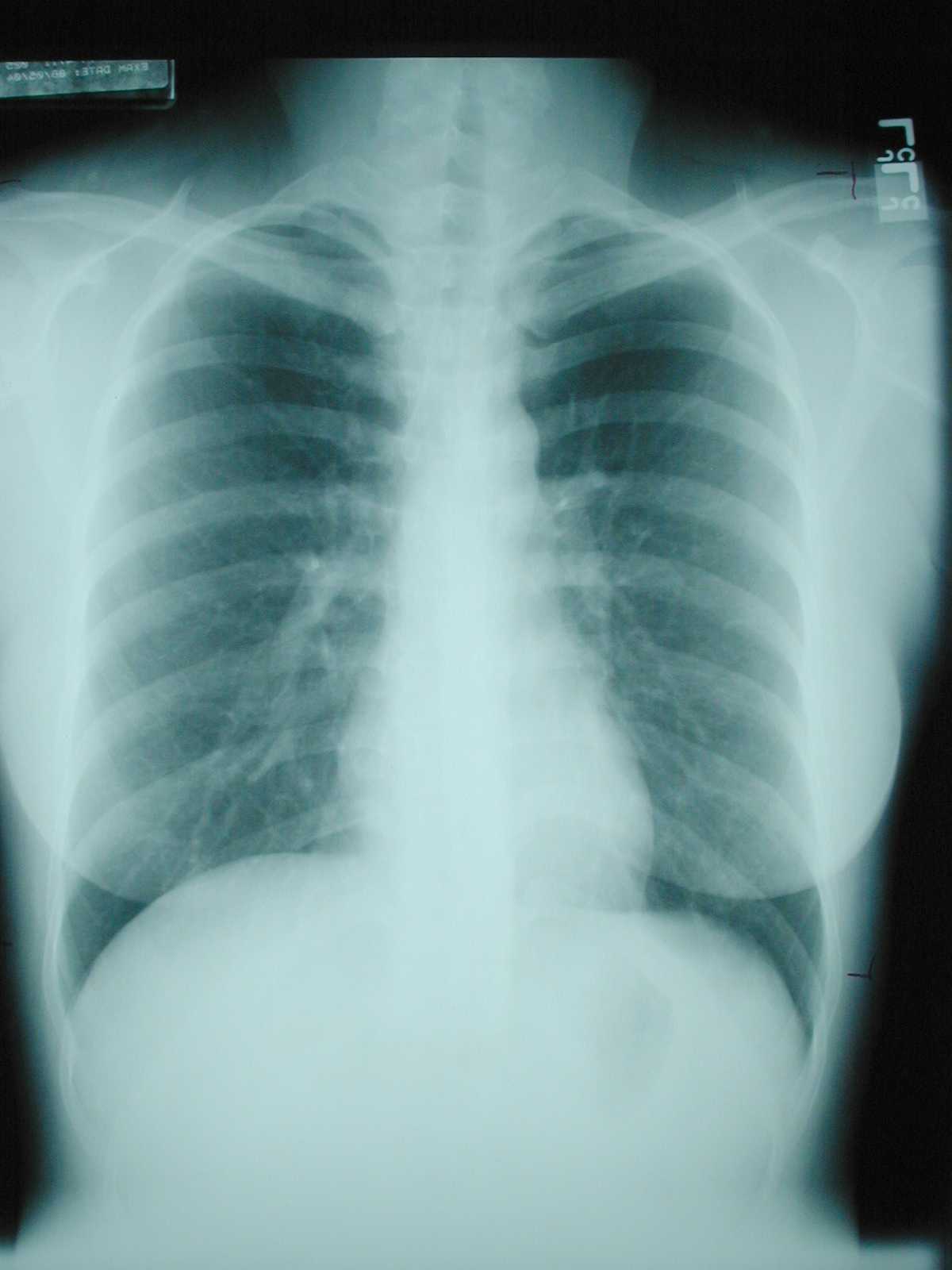 LearningRadiology-Recognizing a Technically Adequate Chest X-Ray