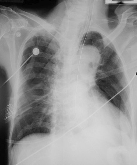 LearningRadiology-Recognizing a Technically Adequate Chest X-Ray