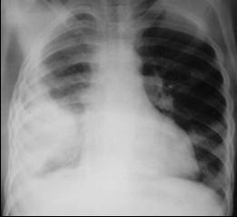 LearningRadiology-Recognizing Pleural Effusions