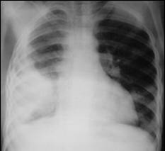 LearningRadiology-Recognizing Pleural Effusions