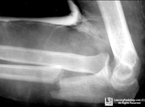 difference between monteggia and galeazzi fracture