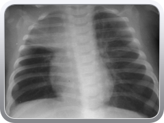 Prior to 1950, children who were thought to have an enlarged thymus were subjected to neck irradiation which caused shrinkage of the thymus but subsequently increased the incidence of thyroid carcinoma.