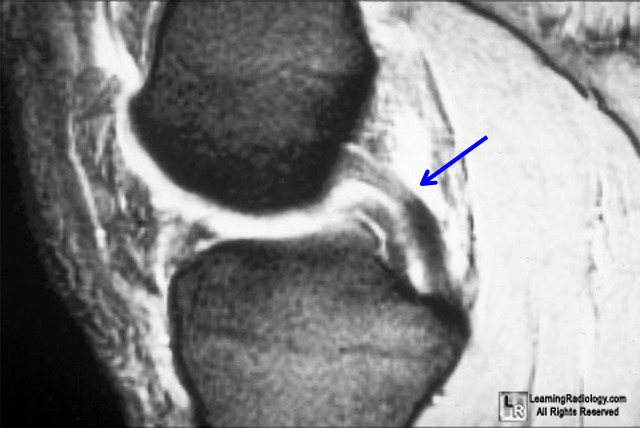 Welcome to LearningRadiology - radiology, radiologic, imaging, signs ...