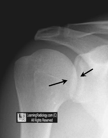 Welcome to LearningRadiology - radiology, radiologic, imaging, sign ...